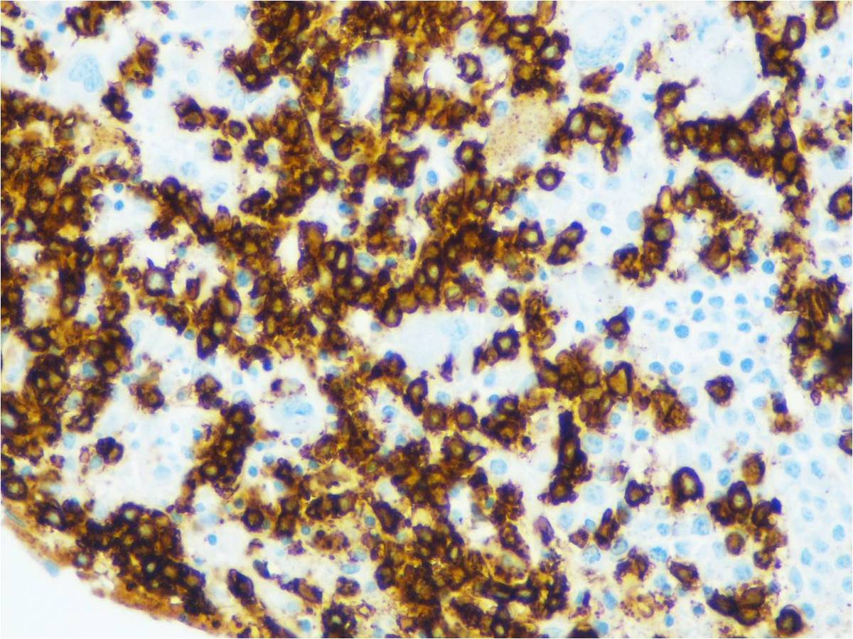 Bone marrow biopsy: CD20